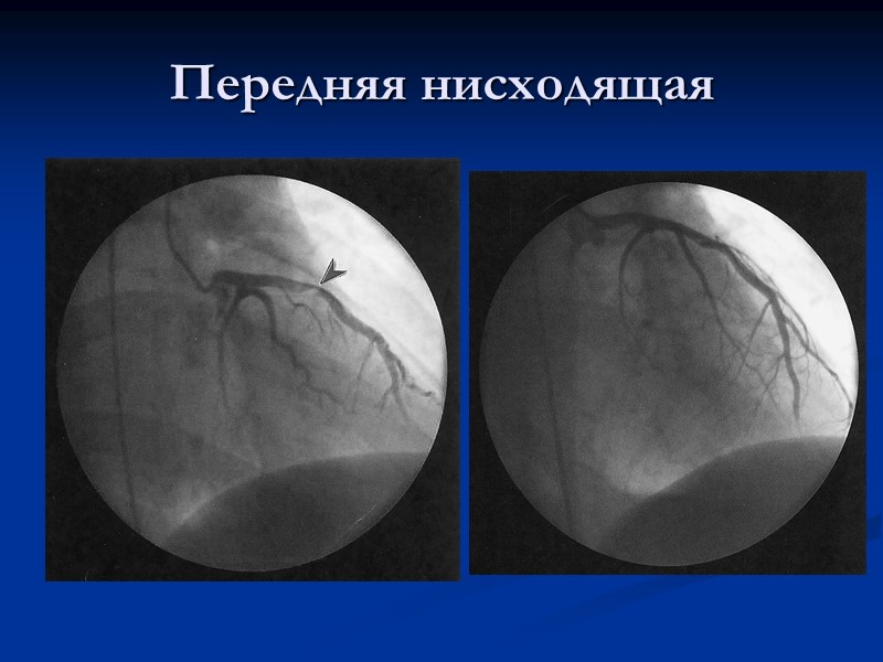 Передняя нисходящая